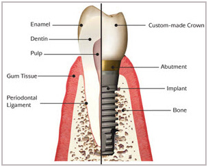 Dental-implants